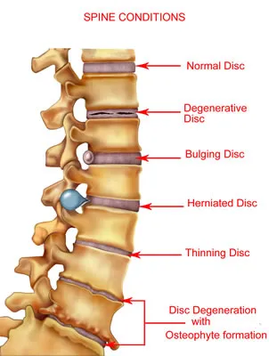 chiro-arthritis