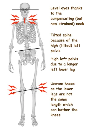 LLI causing neck pain neck pain chiropractor