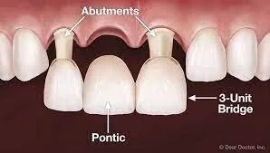 labeled diagram of 3 unit dental bridge with crowns being placed over abutment teeth, crowns and bridges Newark, CA
