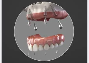 all on 4 dental implants fort lauderdale fl