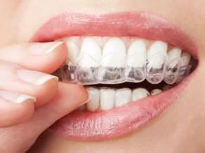 hand holding clear teeth aligners in mouth, Invisalign Los Angeles, CA Beverly Grove