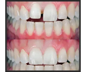 Before and After Veneer