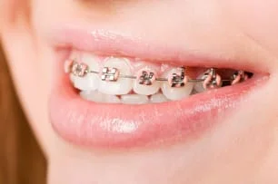 Braces from our Victorville Orthodontist 