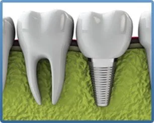 Dental Implant Dentist Fullerton CA