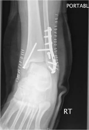 fracture with internal fixation