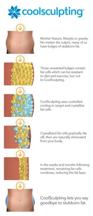 CoolSculpting Fat Reduction Procedure - Divine Medical & Cosmetic Skin  Centres