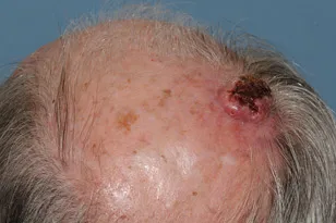 Squamous Cell Carcinoma