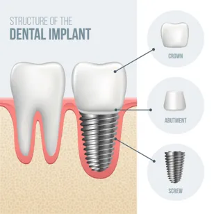 illustration "Structure of the Dental Implant" showing separate parts of implant embedded next to natural tooth, General Dentist Magnolia, TX 