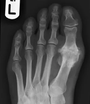  Image of big toe joint arthritis 