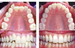 Crowned and Misaligned Teeth