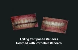 Failing Composite Veneers