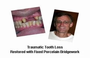 Traumatic Tooth Loss
