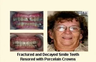 Fractured and Decayed Teeth