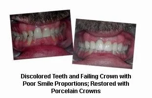 Discolored Teeth and Failing Crowns