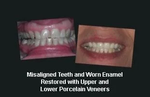 Misaligned Teeth and Worn Enamel