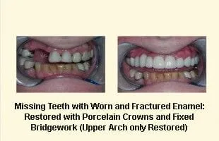 Missing Teeth with Worn and Fractured Enamel
