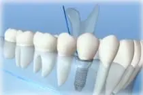 Caledonia Dental Implants