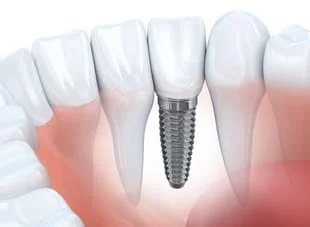 illustration of embedded dental implant next to natural teeth and roots, dental implants Plano, TX dentist