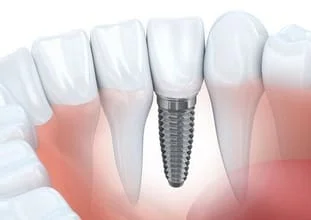 computer illustration of lower teeth and gums, embedded implant next to teeth, dental implants Reno, NV dentist