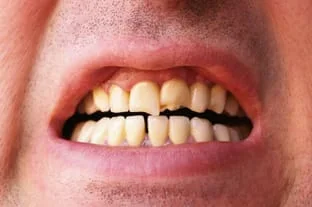 Man with cracked teeth needing Emergency Dentistry North York ON