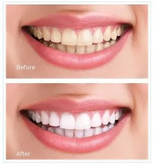 Home whitening before and after