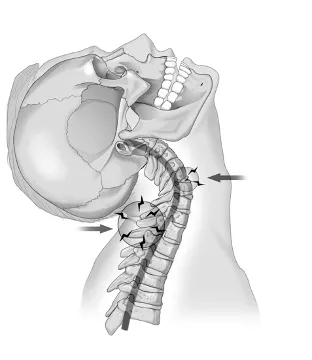 whiplash injury