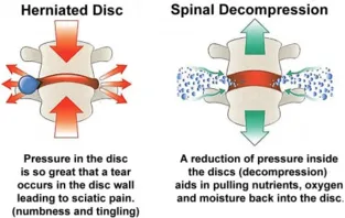 Spinal Decompression Tumwater Lacey