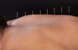 acupuncture on man's back