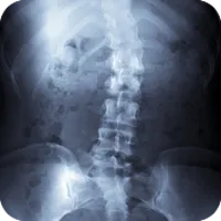 scoliosis_chiropractic.png