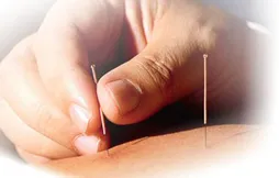 acupuncture_500.jpg