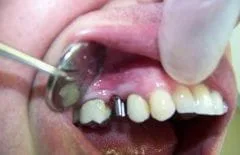 implant_before