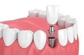 illustration showing crown and implant assembly in mouth, dental implants South Orange, NJ family dentist