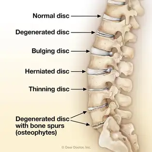 Degenerative Disc Disease | Basalt, Aspen, Carbondale, Spine Spot Chiropractic