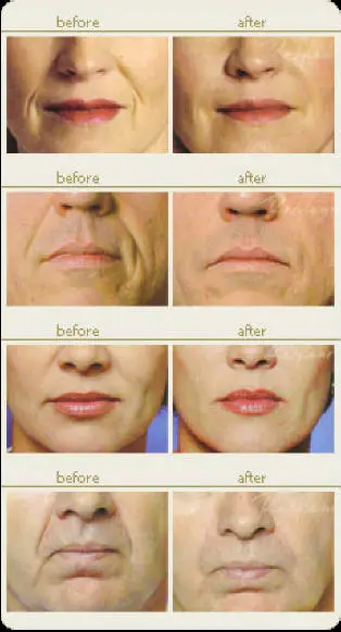 Dermal Fillers