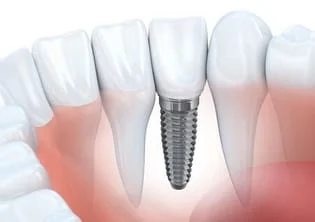 illustration of implant embedded in jaw next to natural teeth, dental implants Hayward, CA dentist