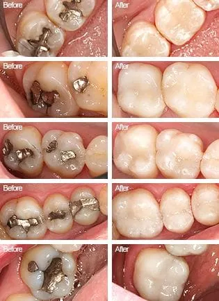 before and after Tooth Colored Fillings Vernon, CT