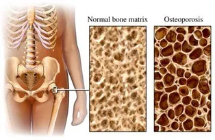 osteoporosis.jpg