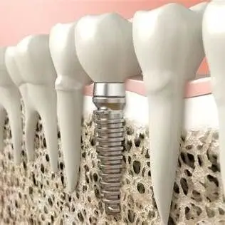 Dental Implants Forest Hills