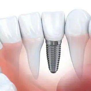 Dental Implants Elmhurst