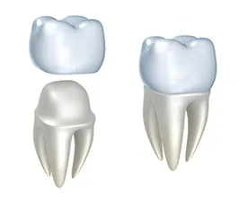 diagram of dental crown assembly Glendale, AZ