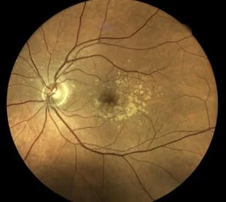 picture of macular degeneration
