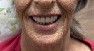 Denture after