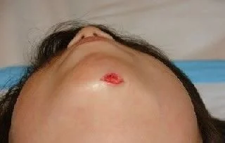 laceration on chin