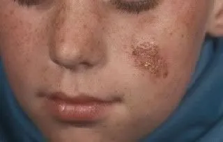 <strong>
</picture>Impetigo of Left Cheek</strong> <p>This shows impetigo on the face. Impetigo is a skin infection caused by bacteria.   The infection causes a red sores which leak fluid.  This area will then dry and become crusty as it heals.</p>