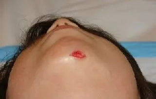 <strong>
</picture>Laceration - Chin</strong> <p>This photo shows a gaping laceration (cut) of the chin. It will require closure with either sutures or skin glue (such as Dermabond).</p><p>First Aid Care Advice:</p><ul><li>Apply direct pressure for 10 minutes to stop any bleeding.</li><li>Wash the cut with soap and water.</li><li>Once the bleeding has stopped, cover with a gauze dressing or adhesive bandage.</li></ul>