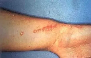 <strong>
</picture>Poison Ivy Rash on Wrist</strong> <p>The oil from the plant leaves irritates the skin. </p><p>The redness and blistering from the rash is often arranged in streaks or lines, because the leaf brushes across the body in a line as a person walks past. </p>