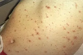 <strong>
</picture>Chickenpox on Abdomen</strong> <p>The Chickenpox rash can occur on all body surfaces. The rash is raised, red and itchy.</p><p>The rash is no longer contagious when all of the spots are crusted over and no new spots are appearing. This usually takes 7 days after the rash first appears.</p>