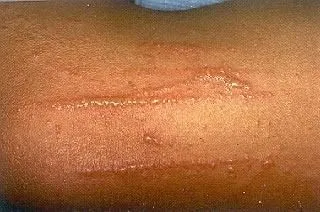 <strong>
</picture>Poison Ivy Rash on Forearm</strong> <p>The oil from the plant leaves irritates the skin. </p><p>The redness and blistering from the rash often appears in streaks or lines, because the leaf brushes across the body in a line as a person walks past. </p>