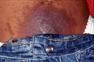 <strong>
</picture>Nickel Allergy</strong> <p>This shows a rash that was caused from the skin touching the snap on the jeans.  This person is allergic to the nickel in the snap. The area is raised and crusty.</p>