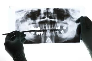 Digital X-Rays | Dr. Turnage | Dentist Spartanburg, SC
